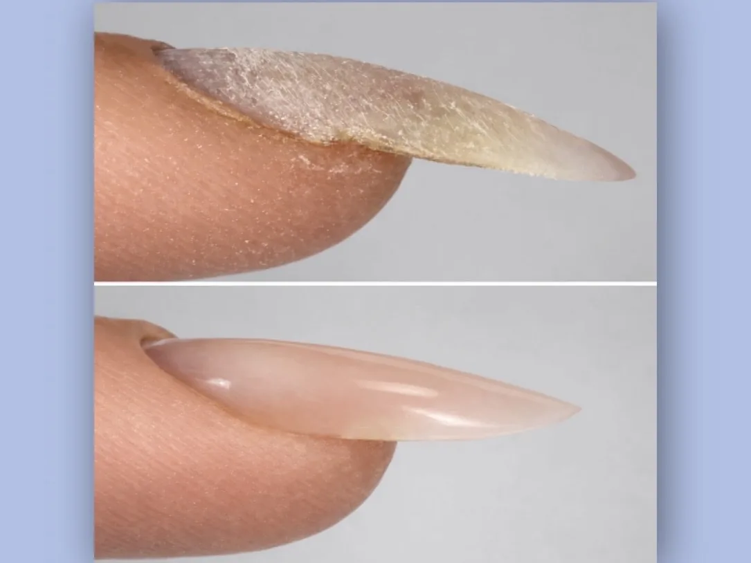 Downward-growing nail correction before and after side profile example